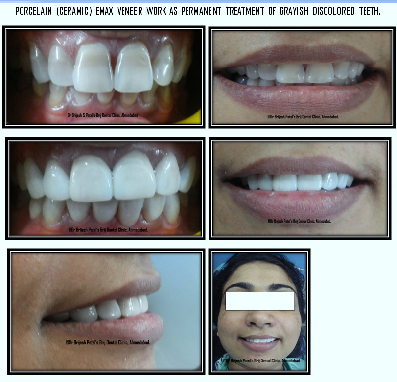4 front teeth veneers
