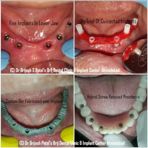 HYBRID IMPLANT PROSTHESIS AT BRIJ DENTAL CLINIC