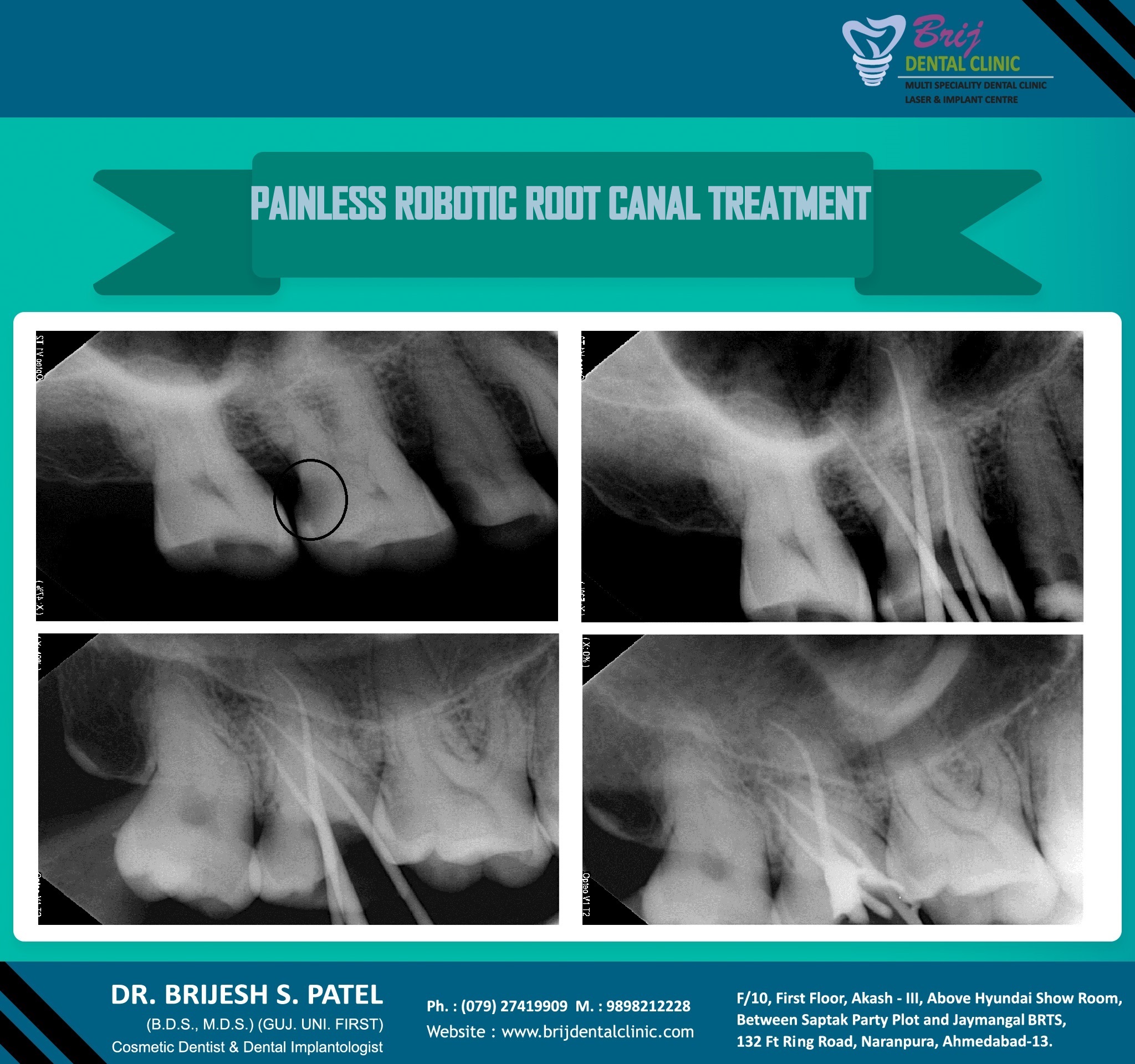 PAINLESS ROOT CANAL TREATMENT (RCT OR ROOT CANAL SURGERY) AHMEDABAD, INDIA