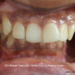 Irregular Procline Teeth, ugly smile