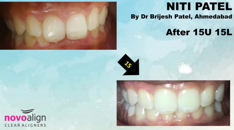 Invisible Clear Braces cost in India by Smile in Hour AHD, BOM, DEL India