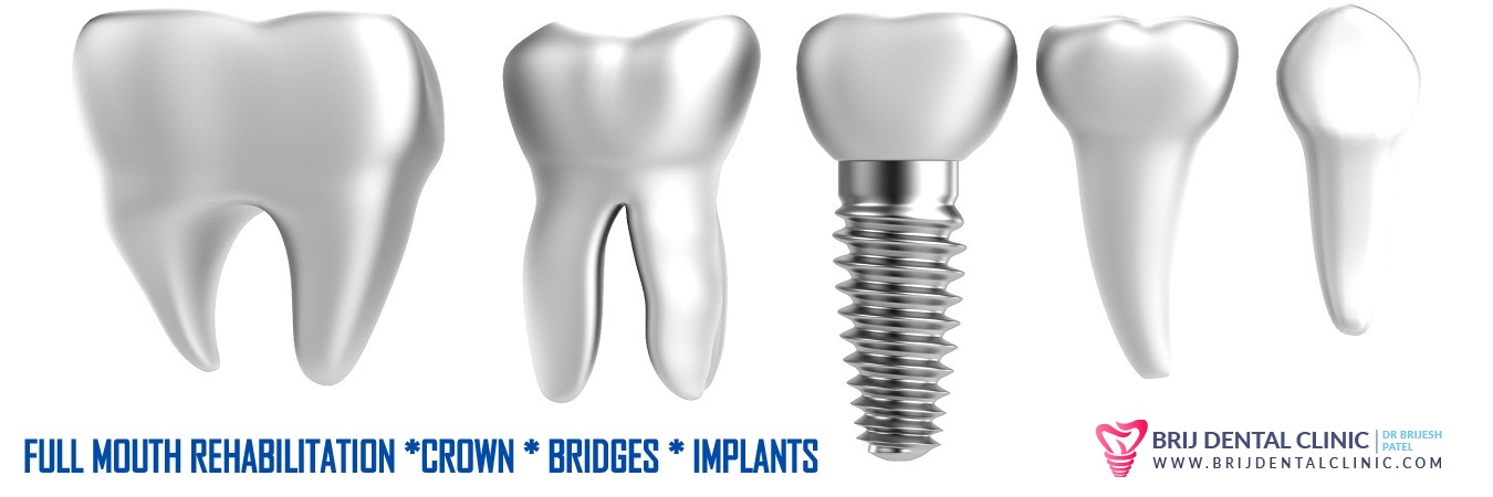 Full mouth Rehabilitation in ahmedabad india