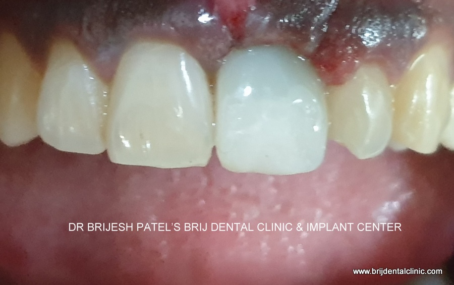 Immediate Temporary PMMA Crown fitted