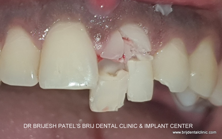 Accident Trauma Broken Front Tooth