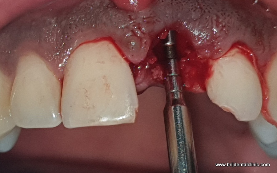 Measuring Defect with Marking Probe