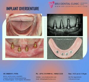 IMPLANT OVERDENTURE