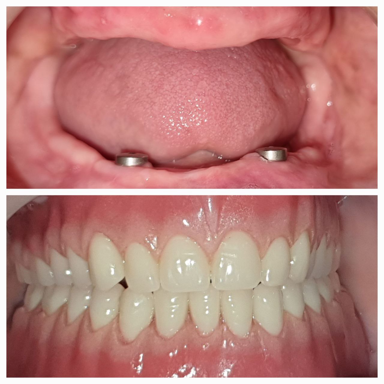 BEFORE AND AFTER DENTURE IN MOUTH