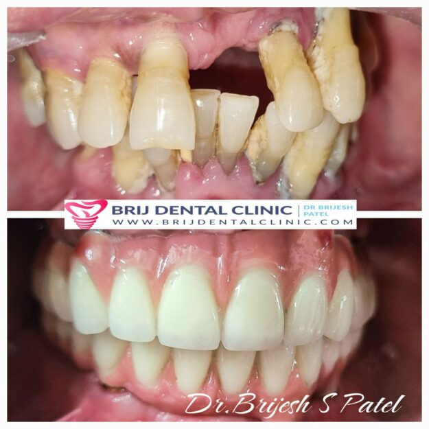 definition of dental prosthesis Stats: These Numbers Are Real