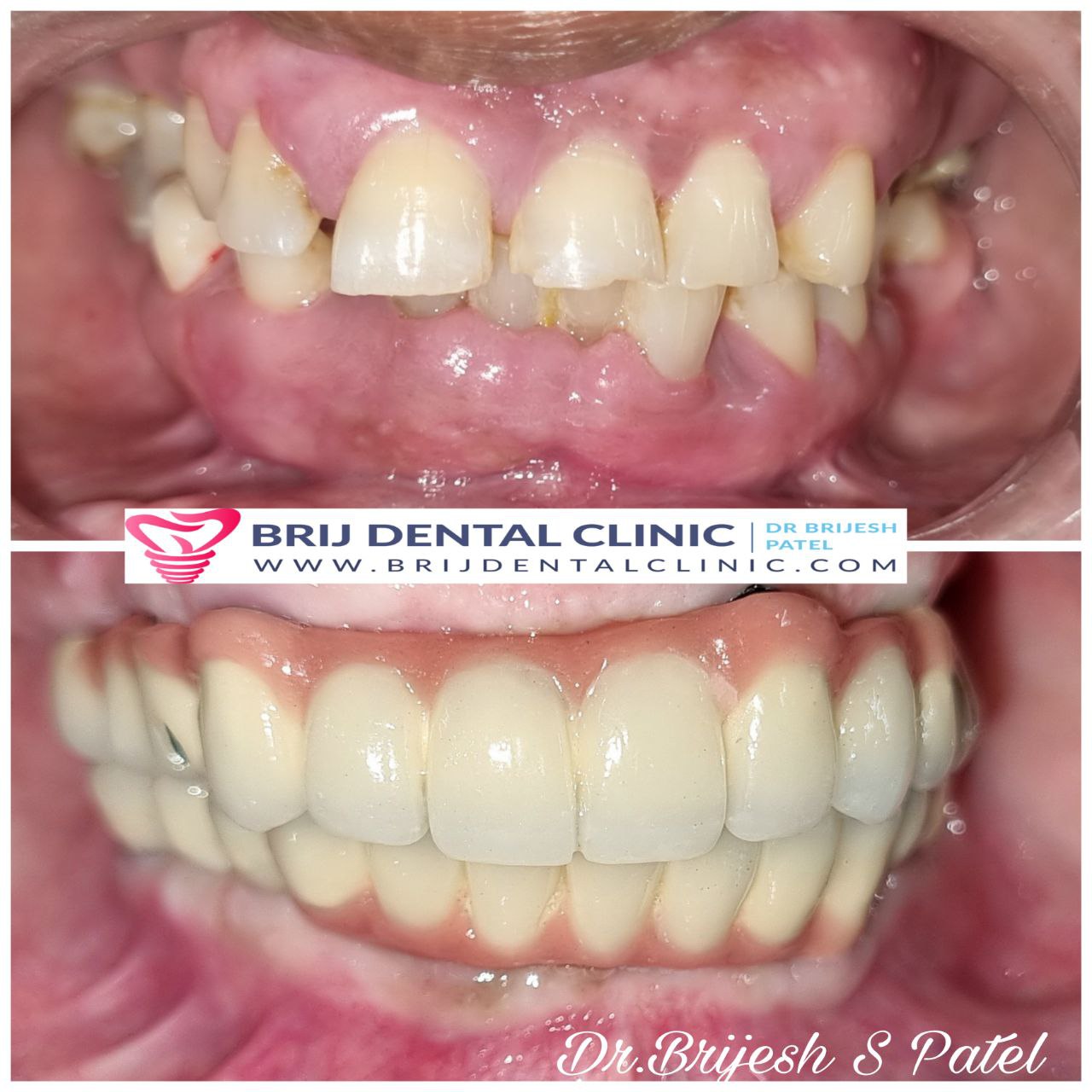 After smile makeover with full mouth dental implants in ahmedabad india