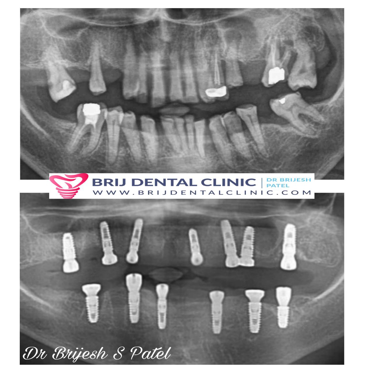 Before and after Full mouth dental implants xray OPG