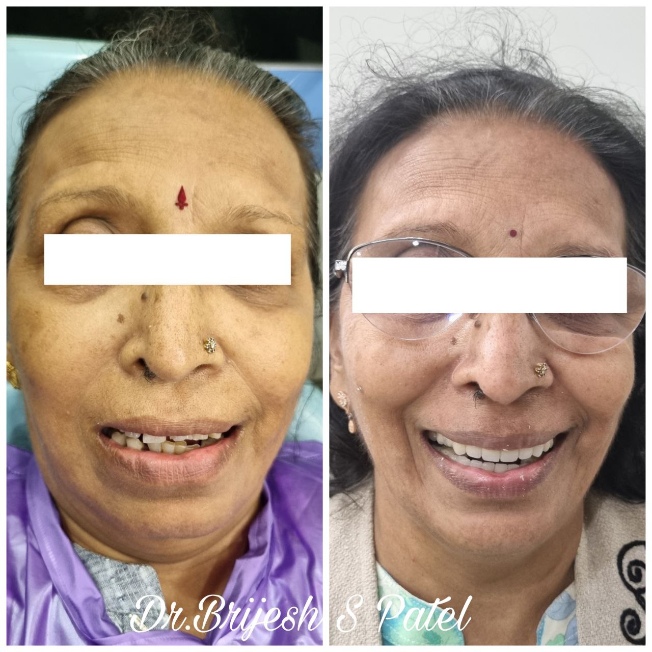 Before and after Full mouth rehabilitation with Dental Implants