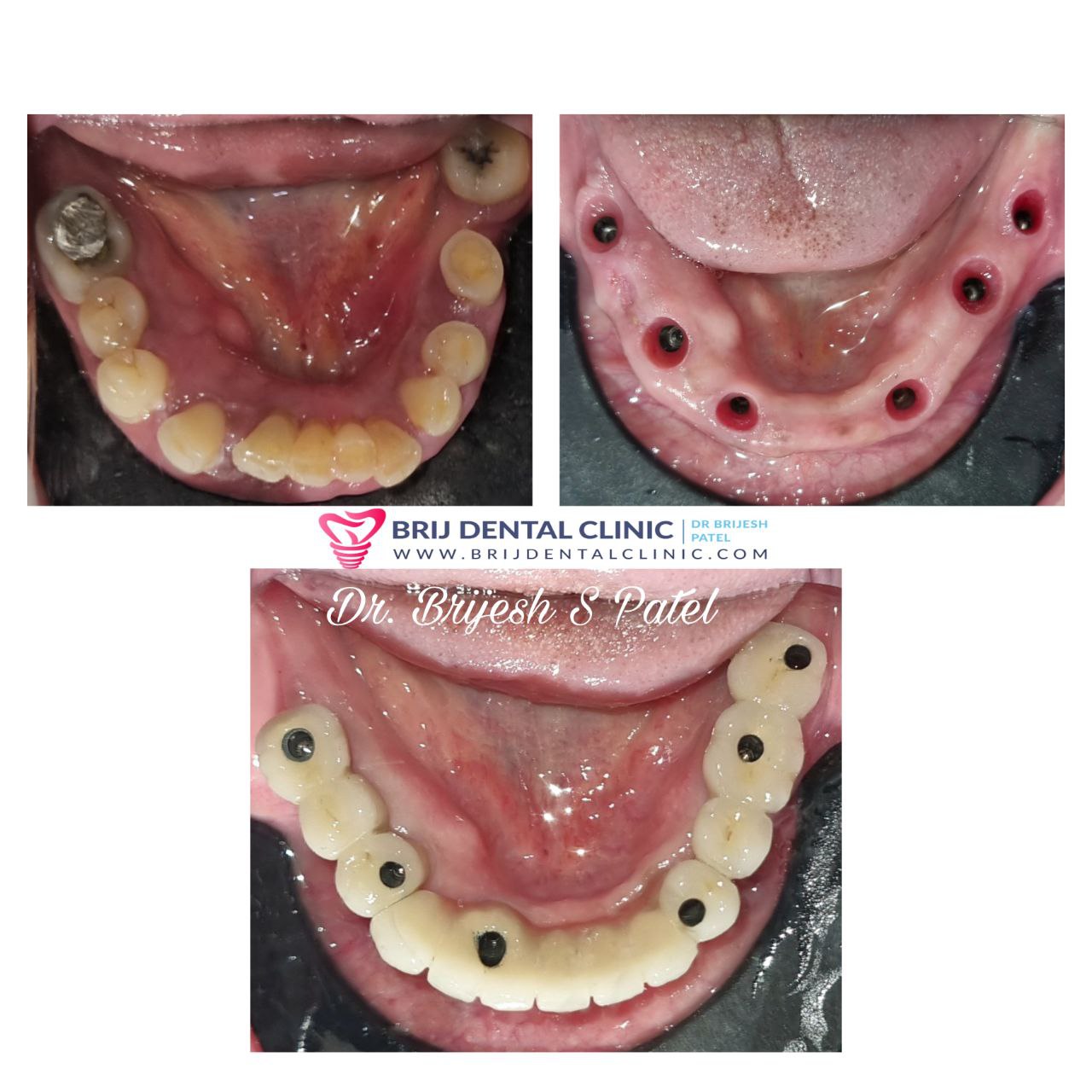 Lower jaw dental implants, abutments, Ceramic Bridge on Dental Implants