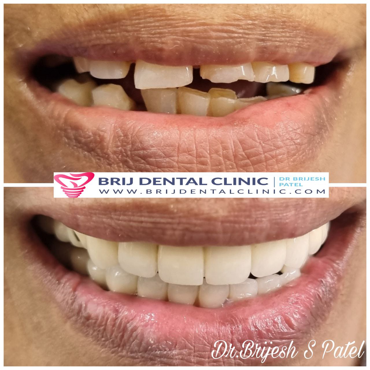 Smile after fullmouth rehabilitation with Dental Implants in ahmedabad