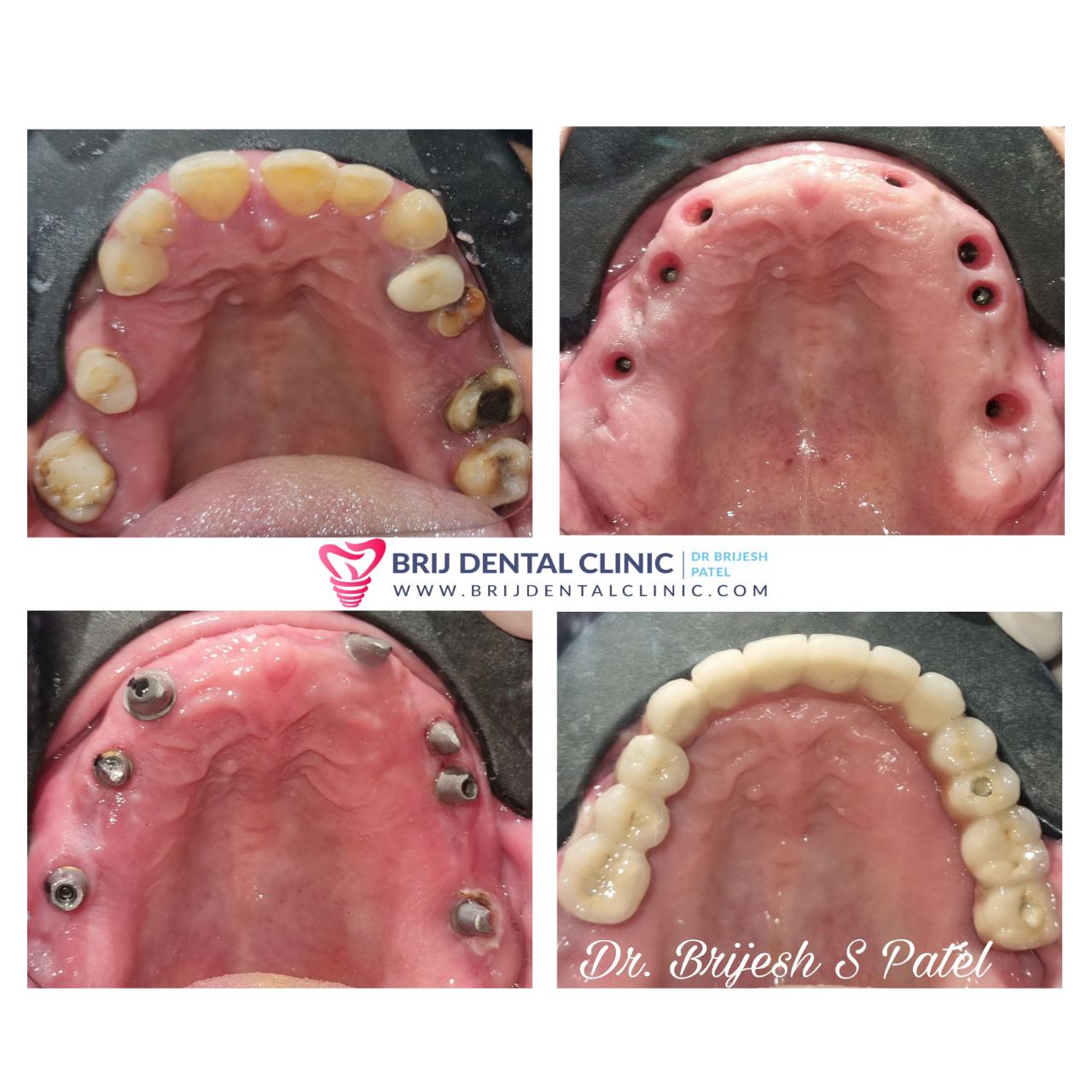 Upper jaw dental implants, abutments, Ceramic Bridge on Dental Implants