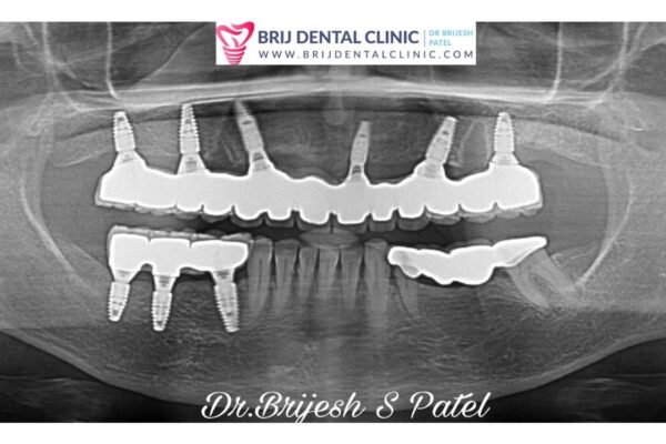 Full mouth Straumann Dental Implants Case