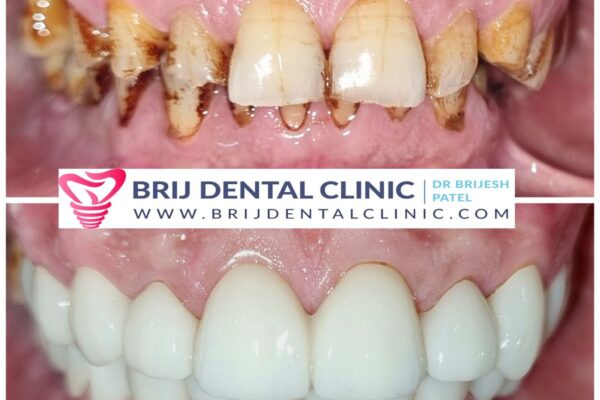 Best Full mouth rehabilitation with Zirconia Teeth