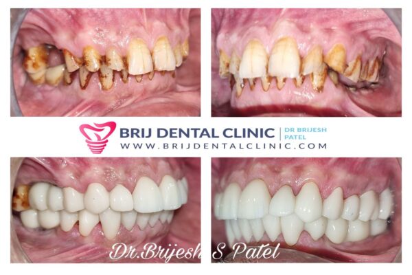 Full mouth rehabilitation affordable Zirconia Teeth