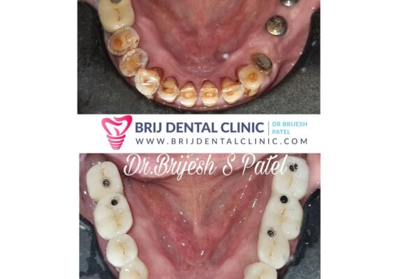 Full mouth rehabilitation with Zirconia Teeth