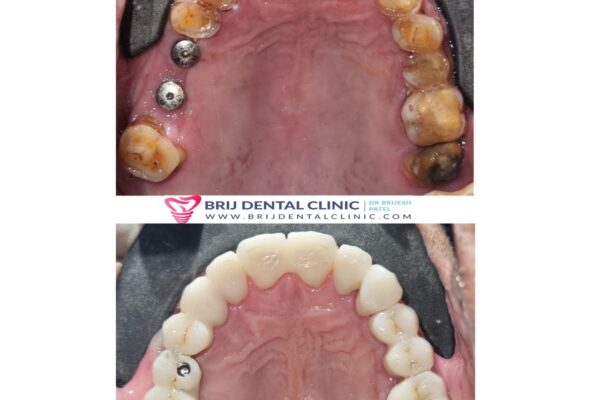 Full mouth rehabilitation with Zirconia Teeth