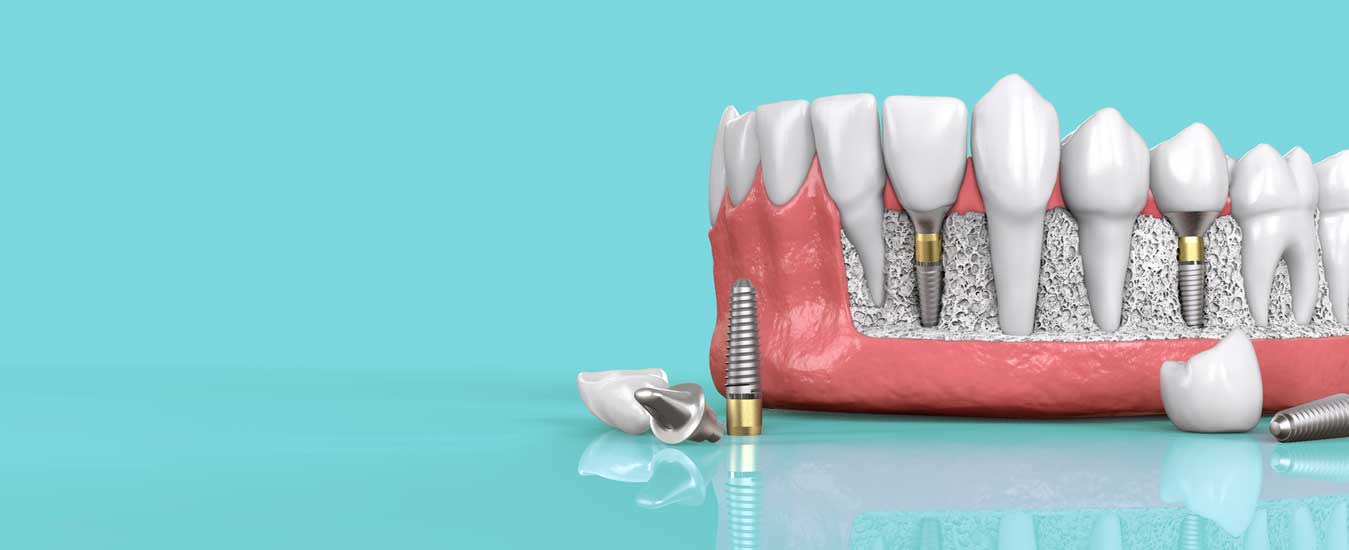 Dental Implant Cost in ahmedabad