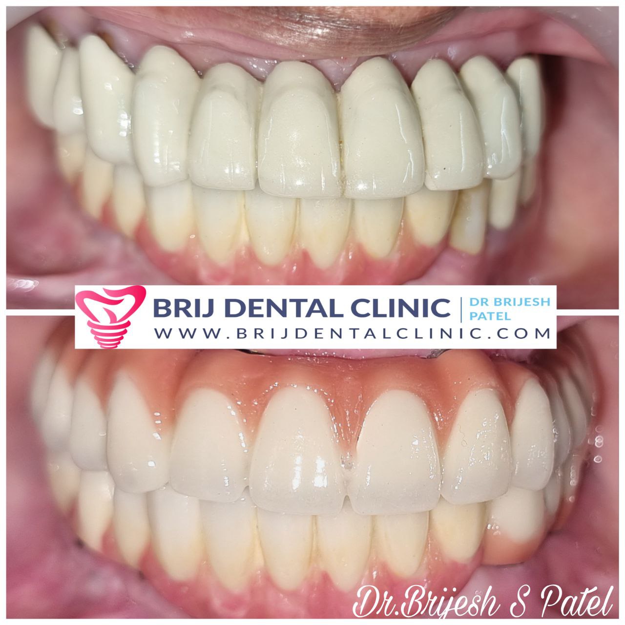 Before Old fractured ceramic bridge, after Dental Implant MLS Ceramic Bridge
