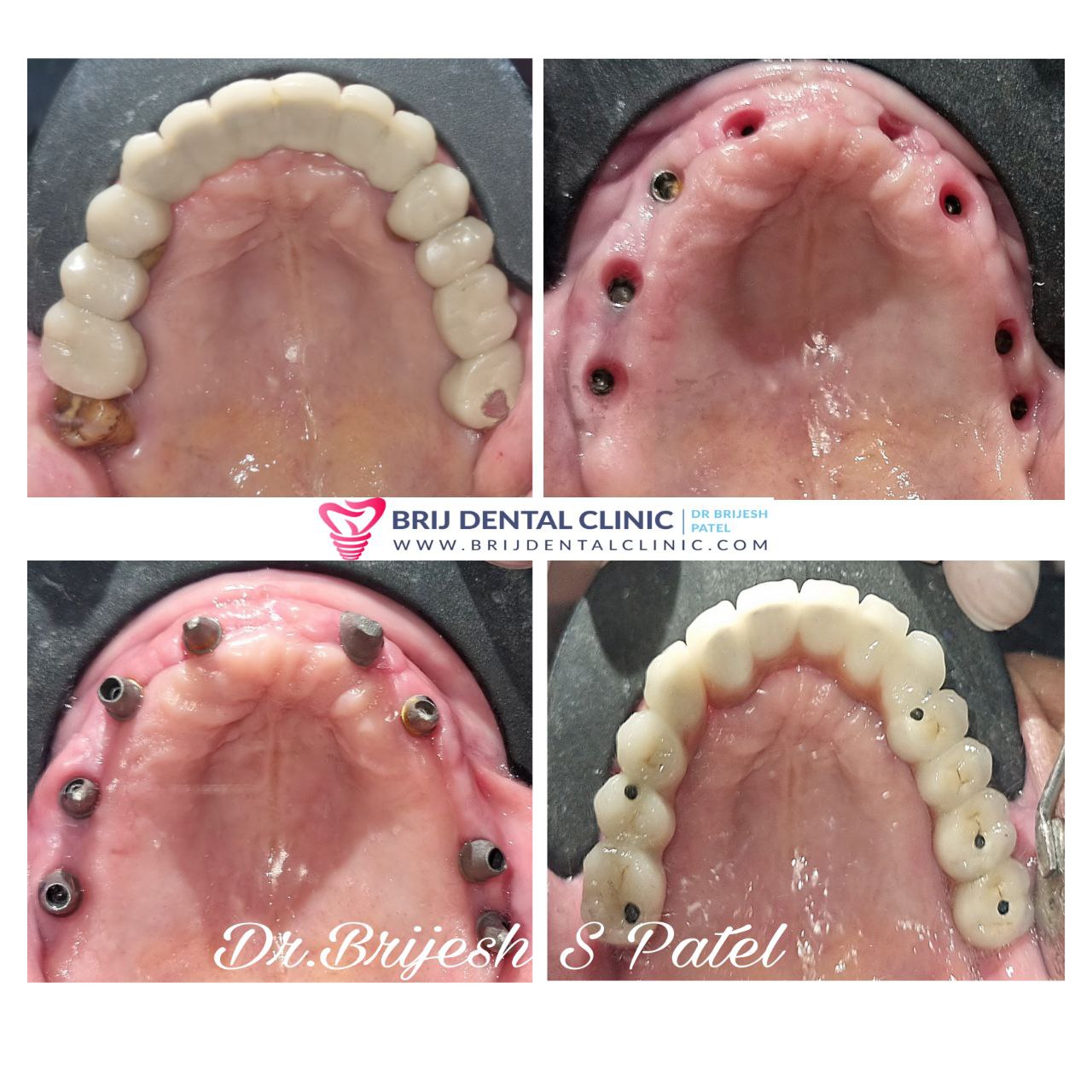 Dental implants for poor bone maxilla and MLS ceramic Bridge