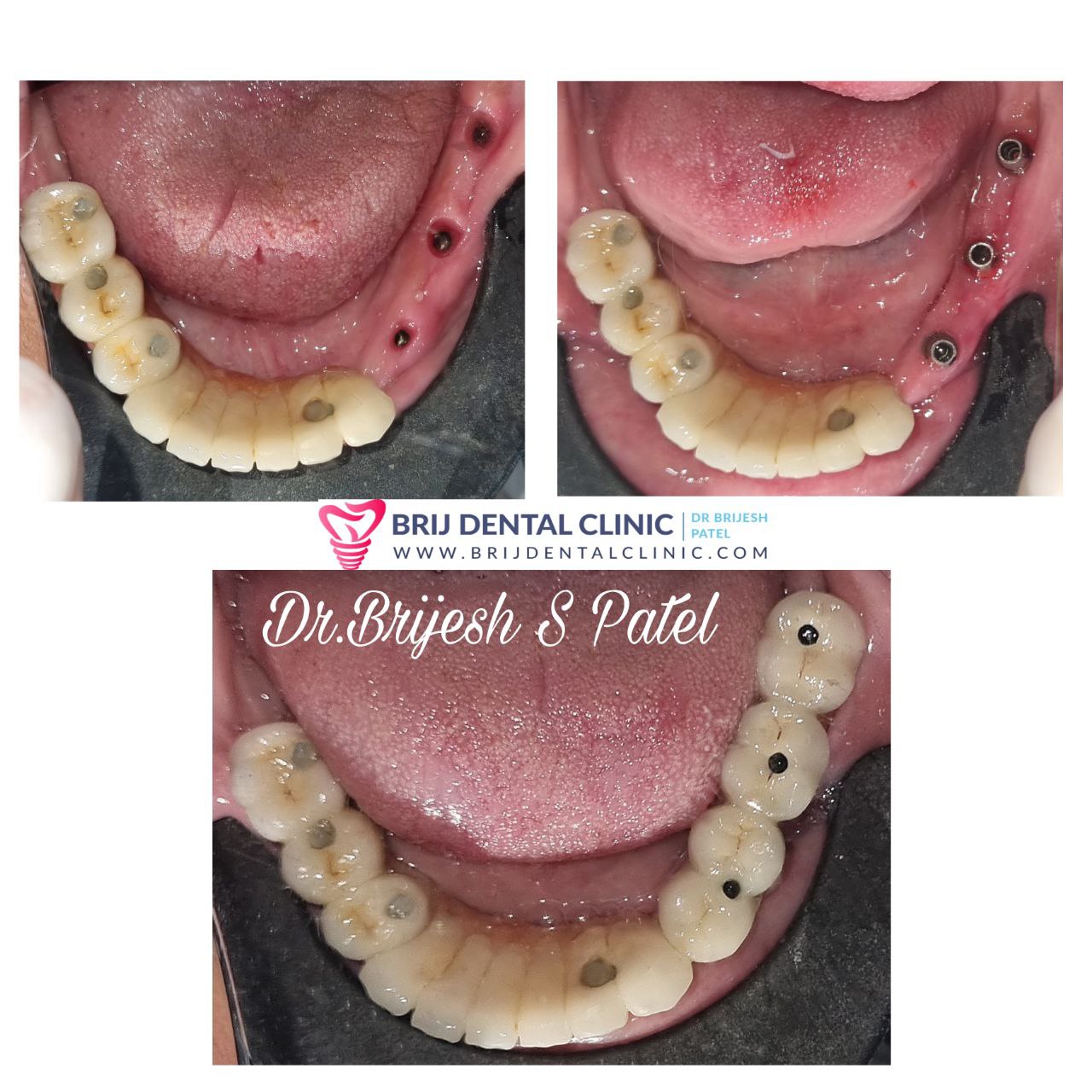Full mouth dental implants in mandible