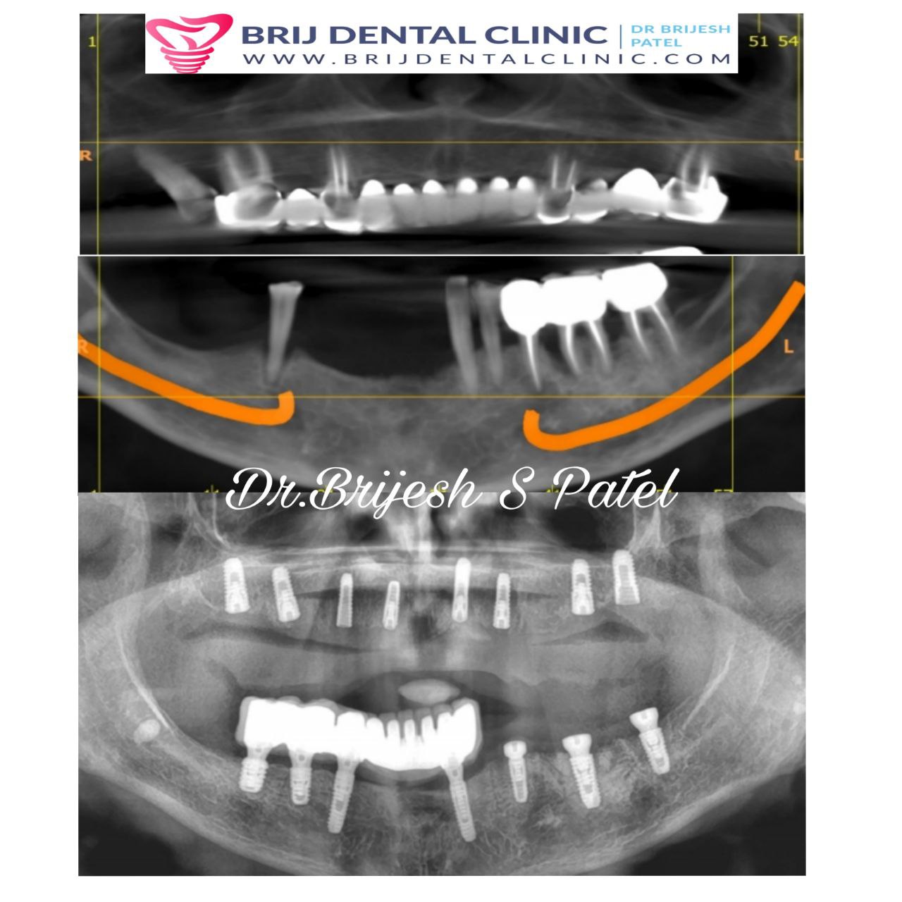 Poor bone in maxilla OPG after dental implant full mouth grafting case