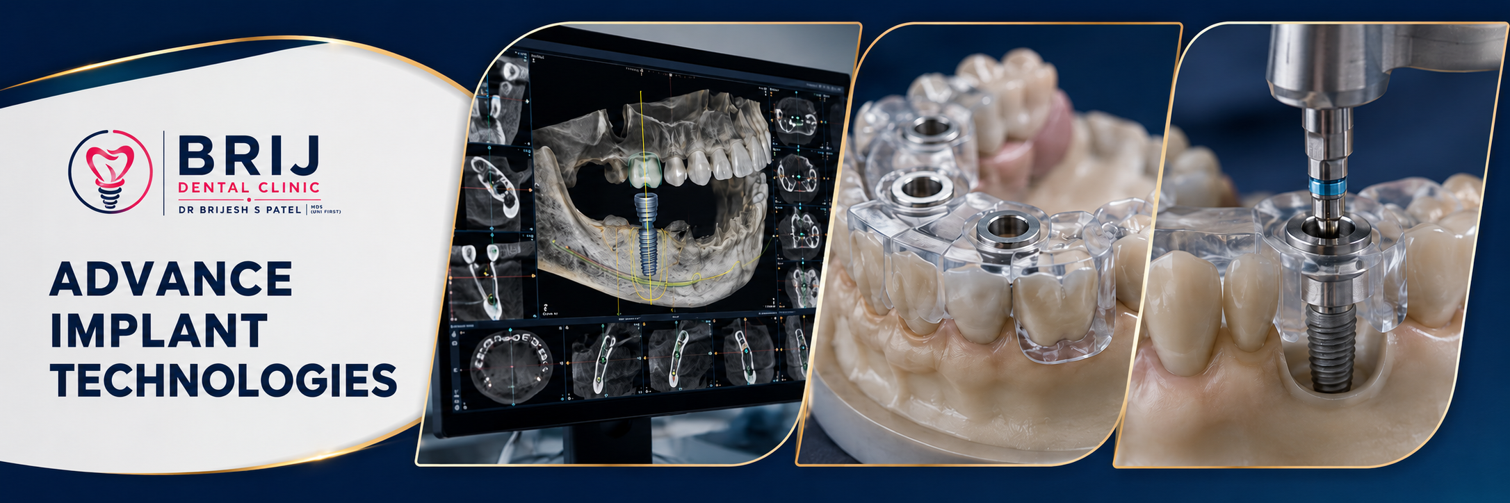 ADVANCE IMPLANT TECH AT BRIJ DENTAL CLINIC NARANPURA AHMEDABAD