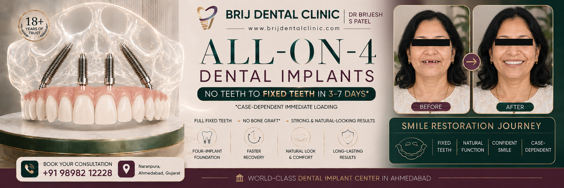 ALL ON 4 DENTAL IMPLANT TREATMENT AT AHMEDABAD INDIA.