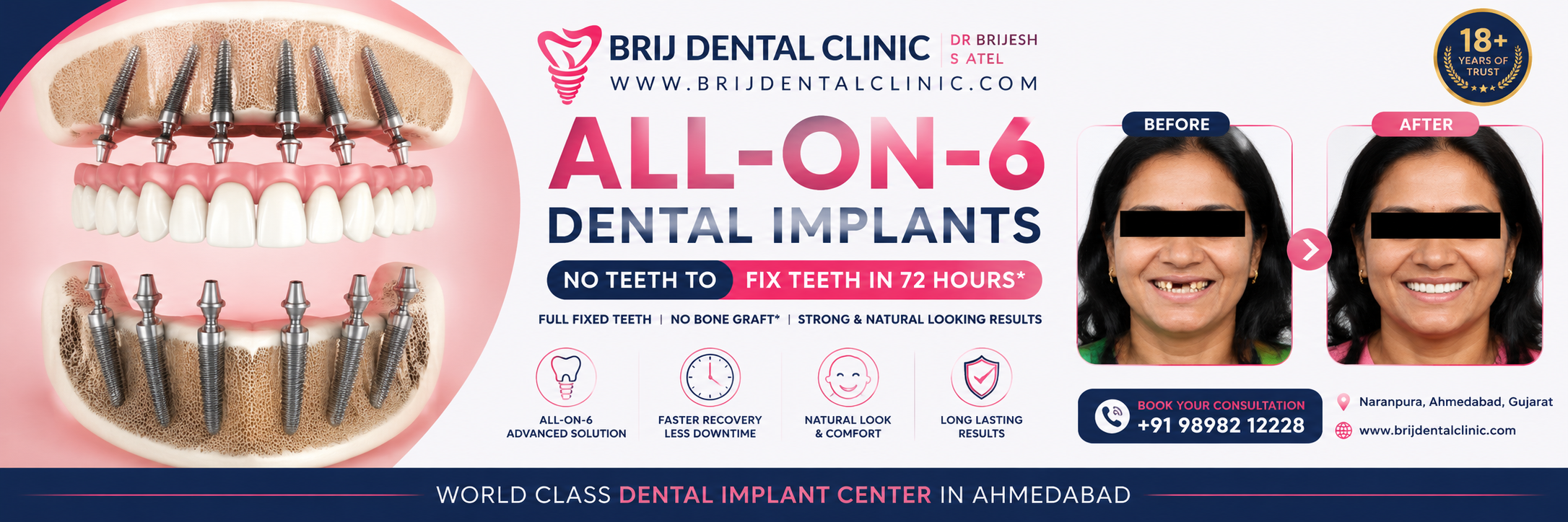 FULL MOUTH DENTAL IMPLANTS COST IN AHMEDABAD INDIA FULL MOUTH DENTAL IMPLANTS COST IN AHMEDABAD INDIA
