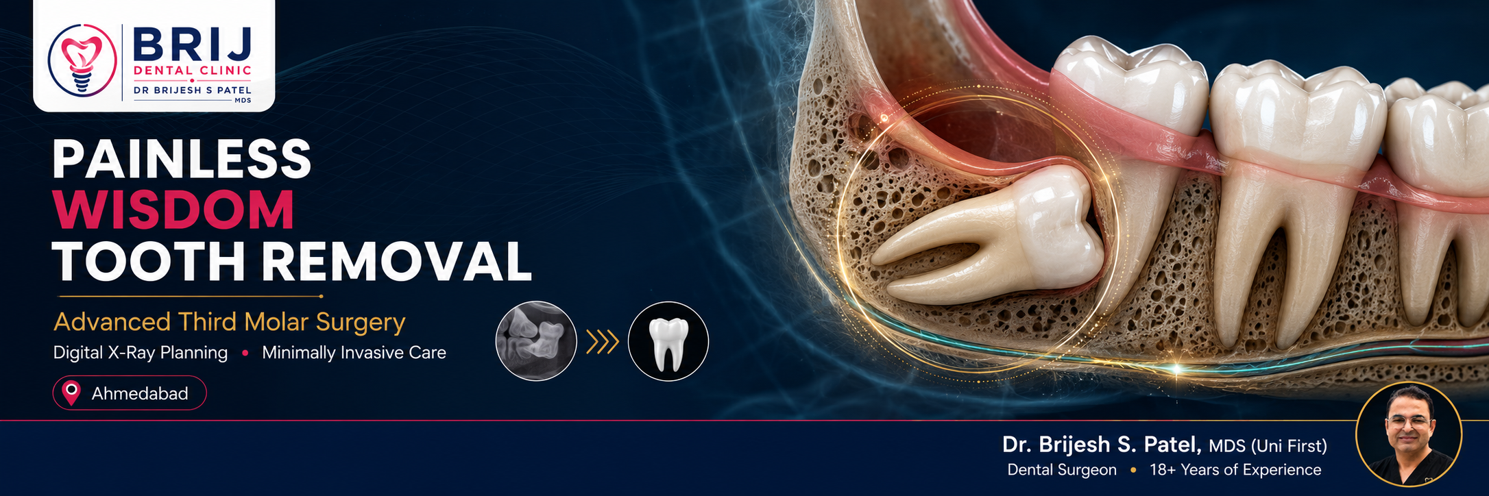 Painless wisdom tooth surgery and dental surgery by Oral surgeon at Brij dental Clinic, Ahmedabad