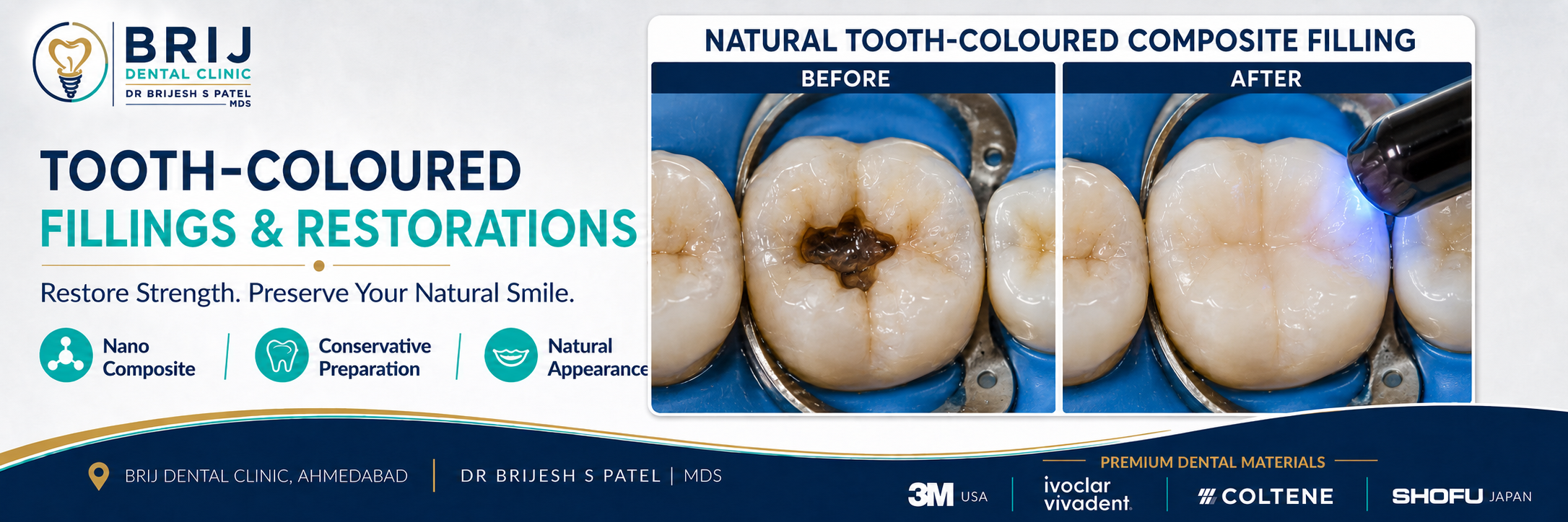 TOOTH COLORED NANO COMPOSITE LIGHT CURE FILLING IN AHMEDABAD INDIA