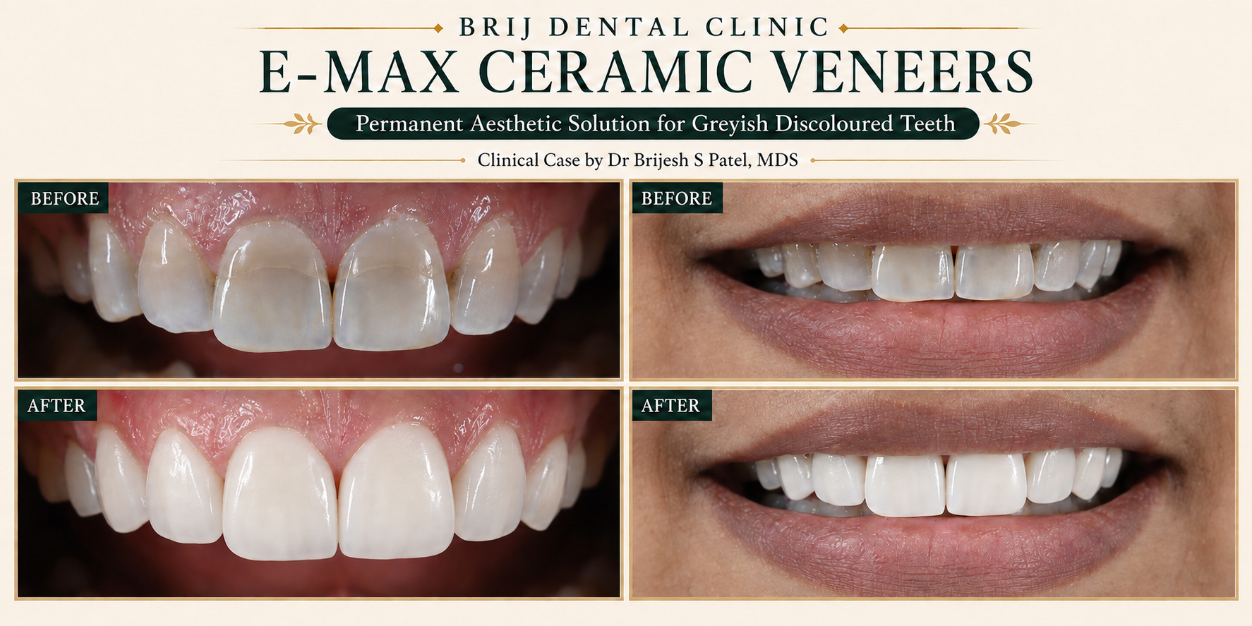 ceramic veneers permanent solution for grey, flourosis teeth