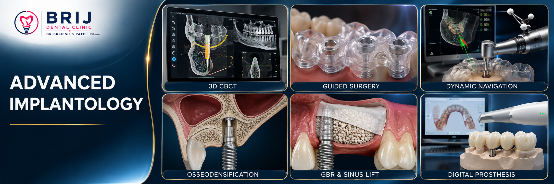 MOST ADVANCE IMPLANT TECHNOLOGY AT BRIJ DENTAL CLINIC AHMEDABAD INDIA