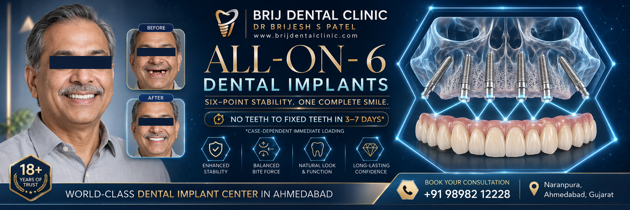 FULL MOUTH DENTAL IMPLANTS COST IN AHMEDABAD INDIA