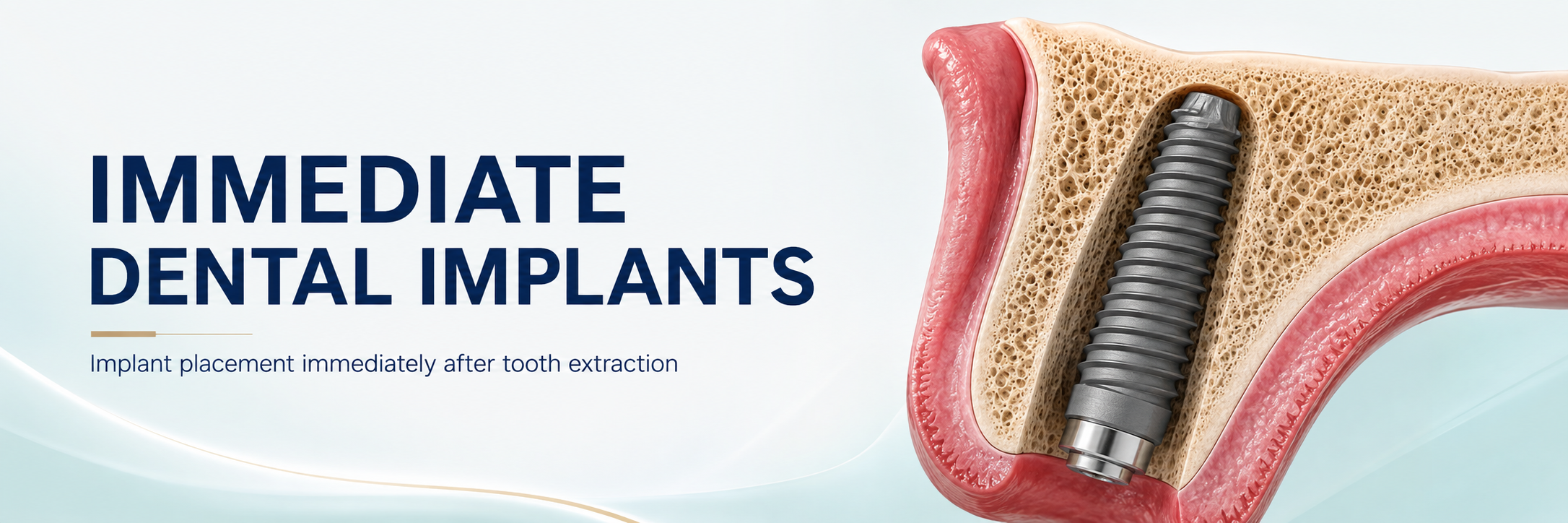 IMMIDIATE DENTAL IMPLANTS AFTER TOOTH REMOVAL AT BRIJ DENTAL CLINIC AHMEDABAD INDIA